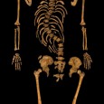 Scoliosis – a lateral or side-to-side curvature of the spine – can be a very painful condition to live with. But some of the treatments practised in the late medieval period would have themselves caused sufferers a lot of anguish.