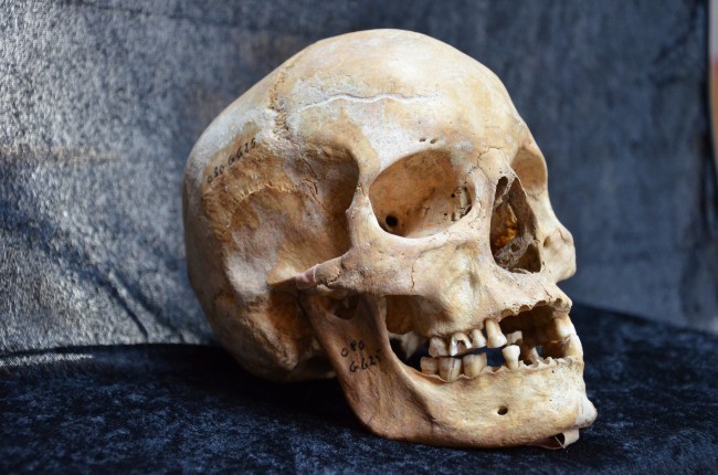 Medieval leprosy victim - photo courtesy University of Birmingham