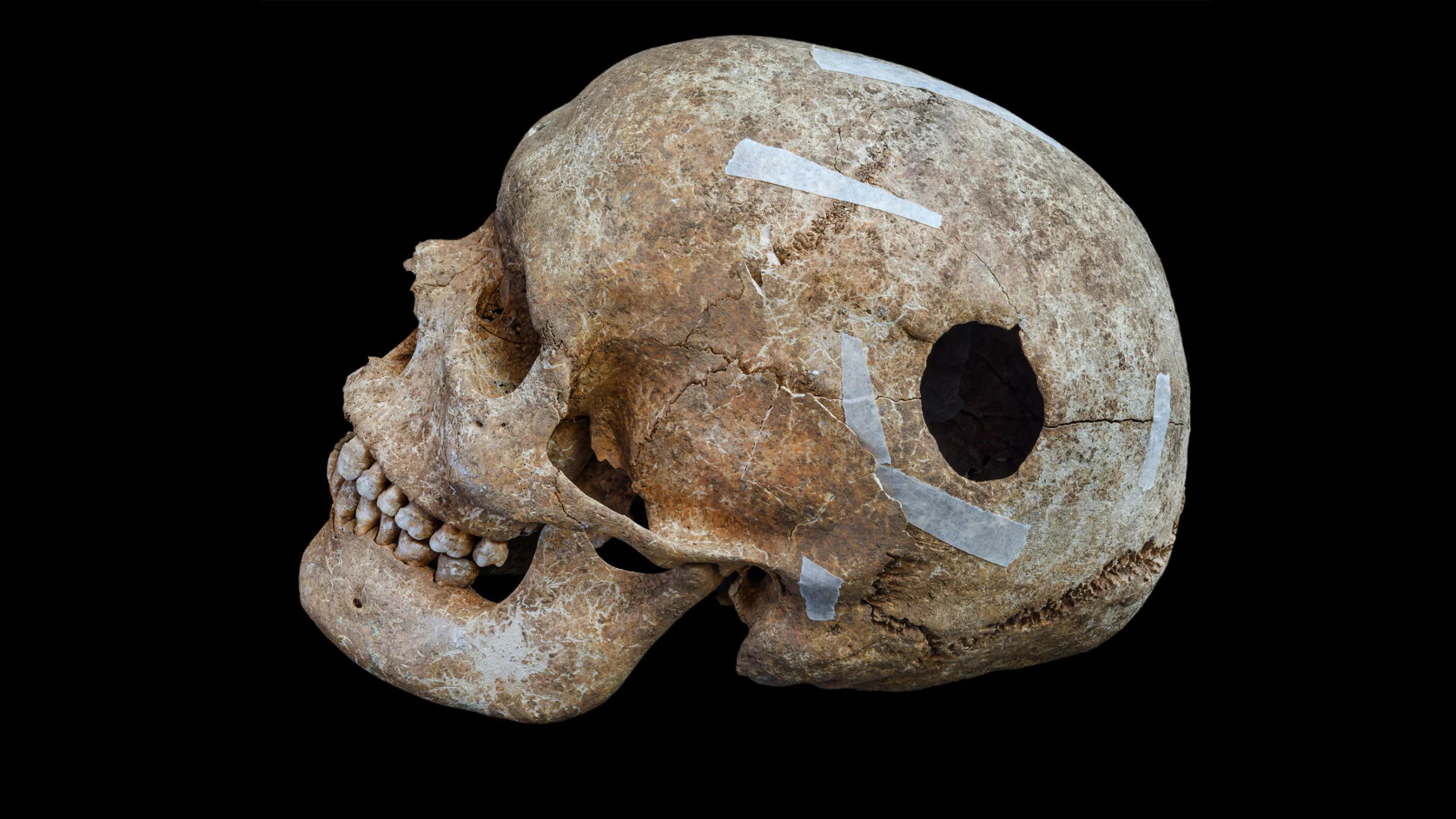Medieval "Giant" with Trepanned Skull Discovered in Mass Grave - Medievalists.net